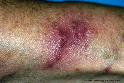 Internal Lesions